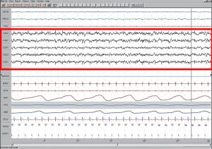 800px-Sleep_EEG_Stage_1